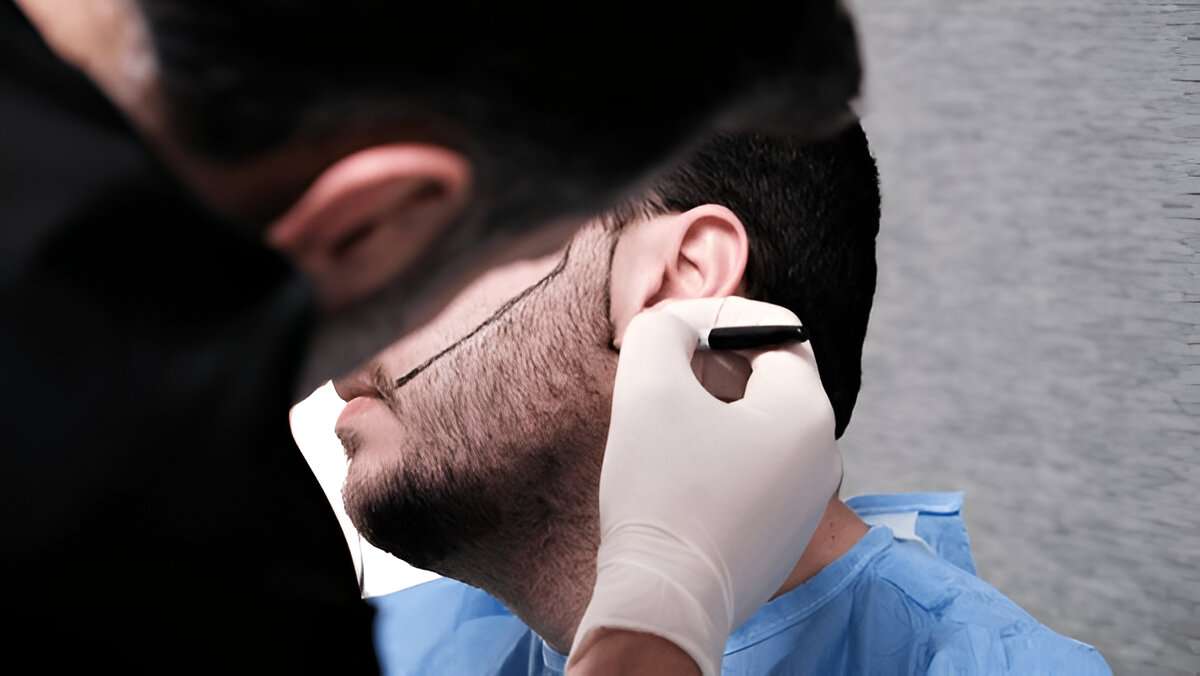 hair transplant