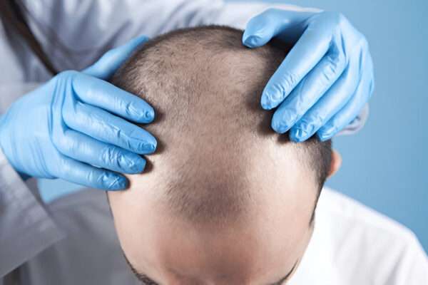 Hair Transplant Results After 6 Months: What to Expect in London Hair Transplant