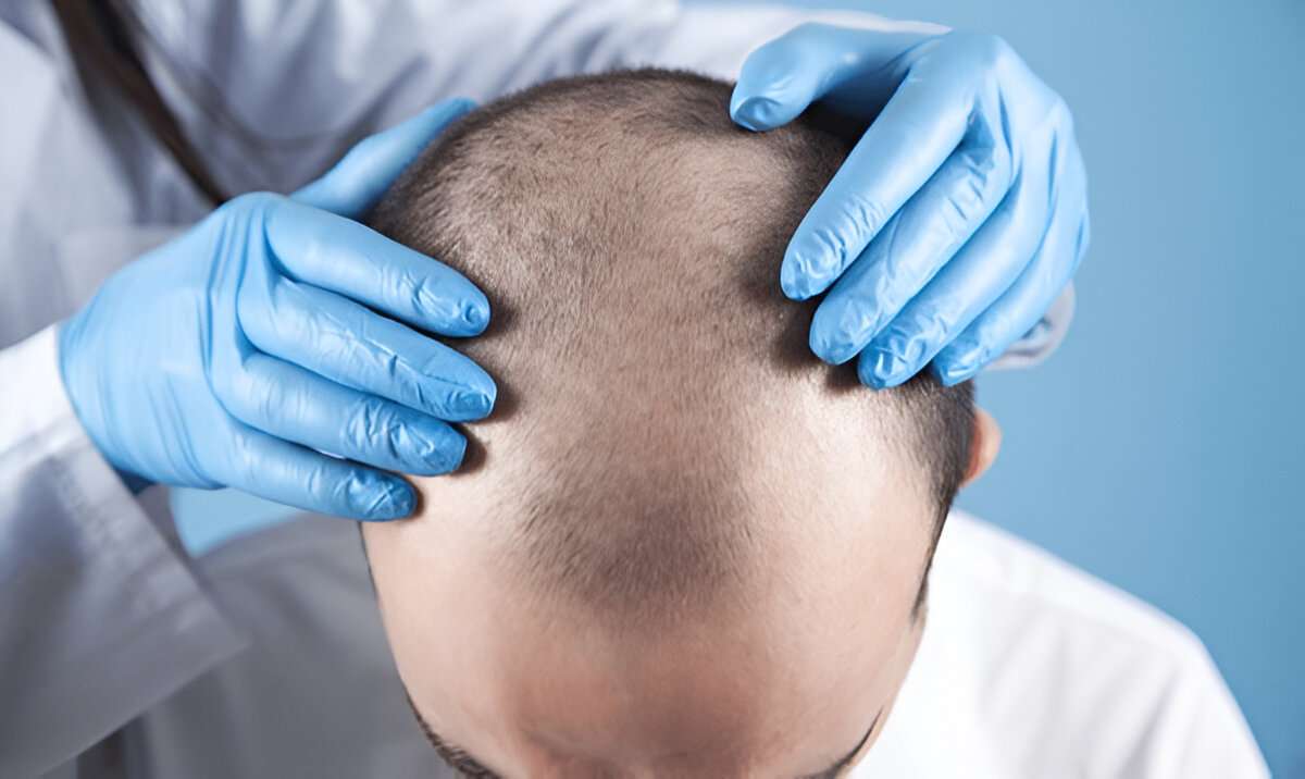 Hair Transplant