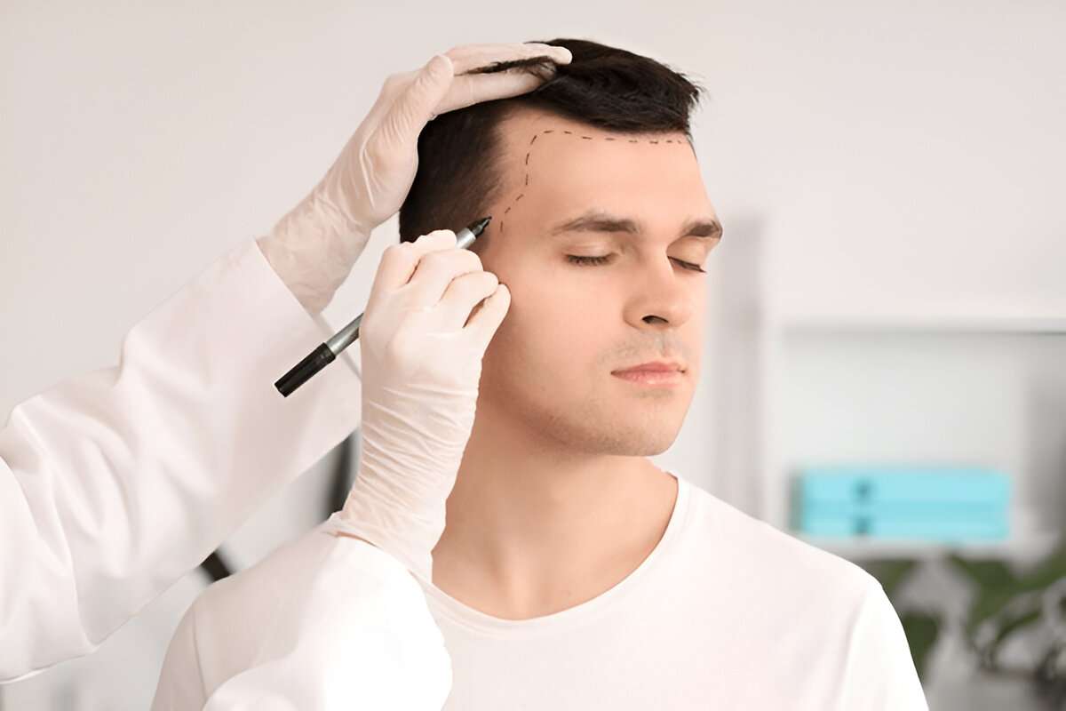 hair transplant London