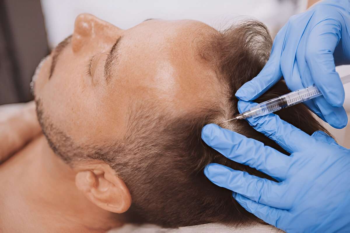 best hair transplant UK