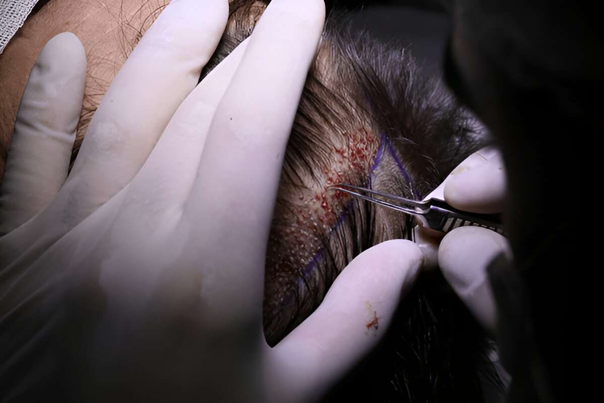 Hair Transplant