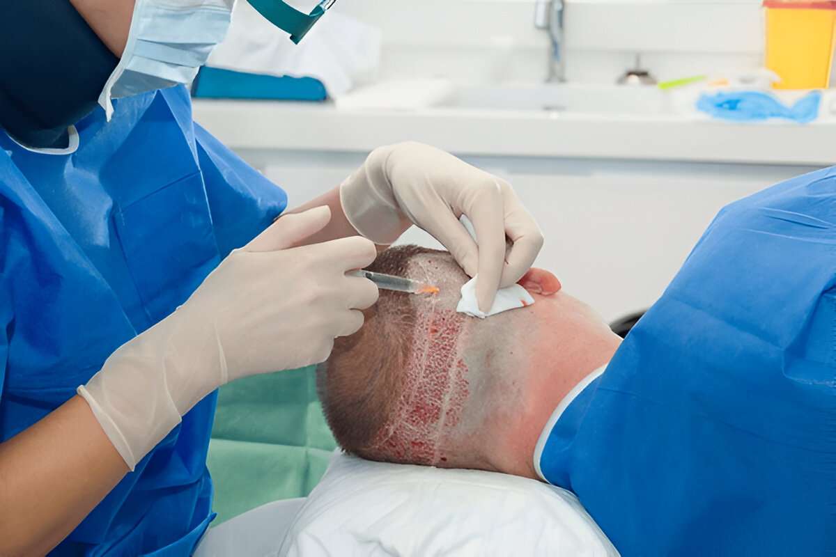 Hair Transplant