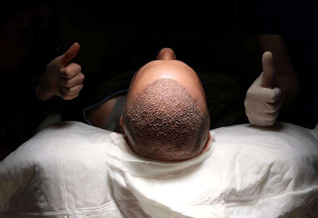 manual hair transplant London