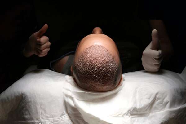 What Makes a UK Hair Clinic Trustworthy? manual hair transplant London