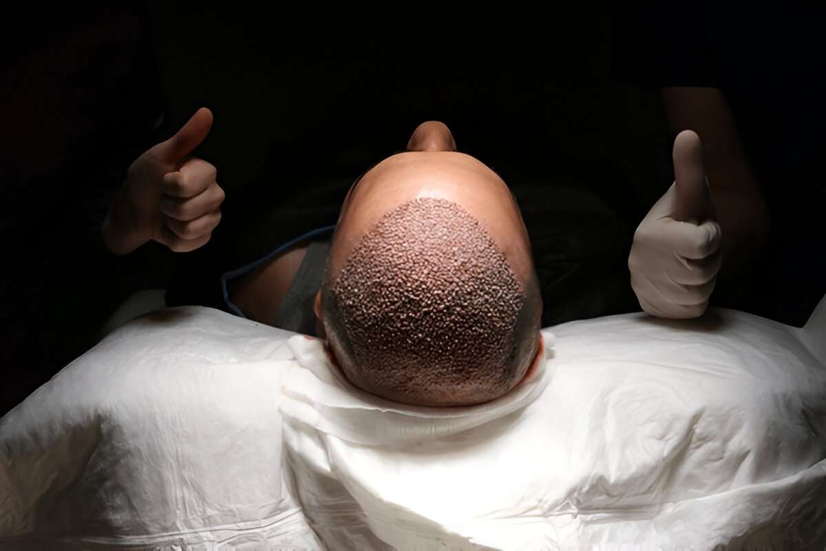 manual hair transplant London
