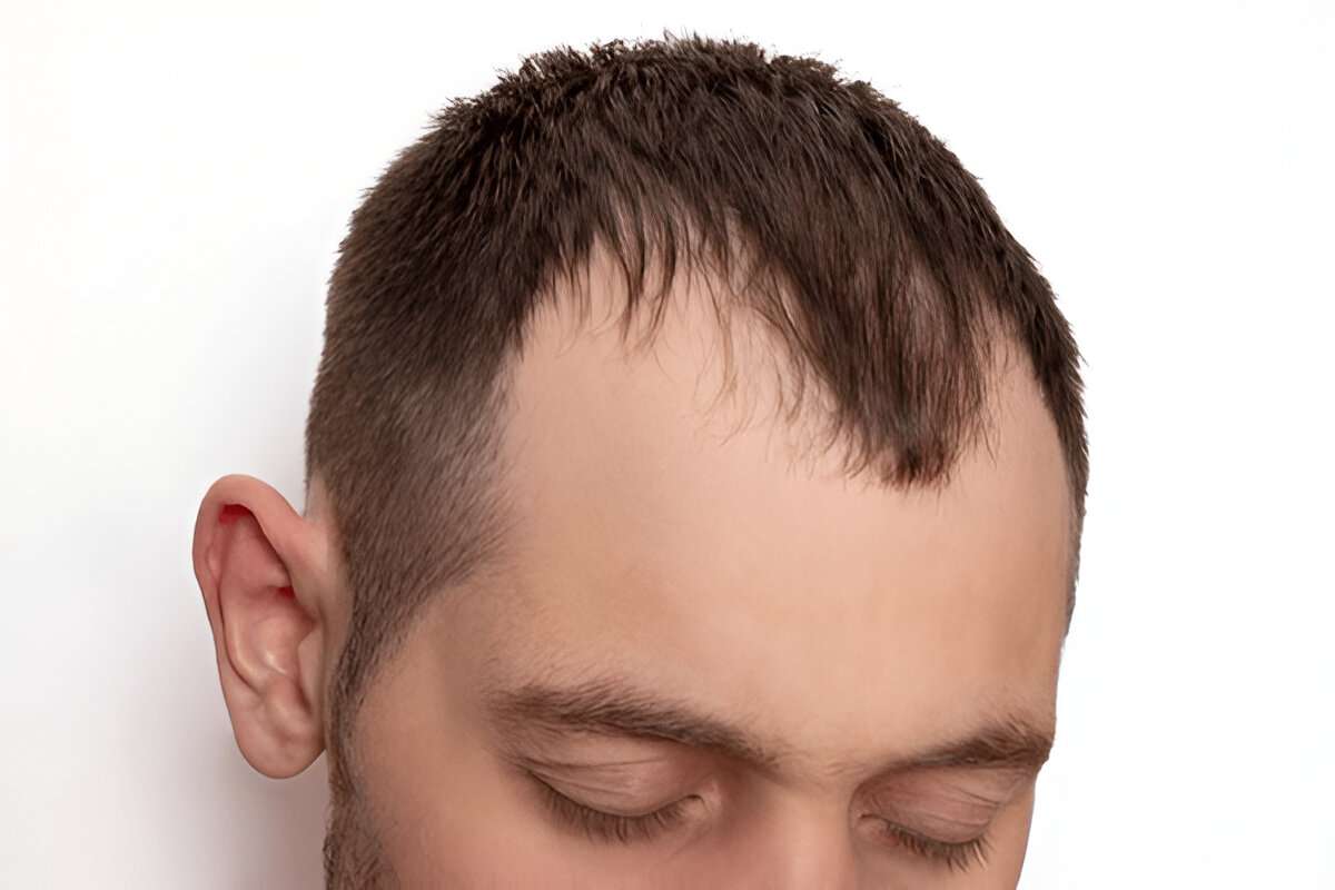 hair transplant Bristol