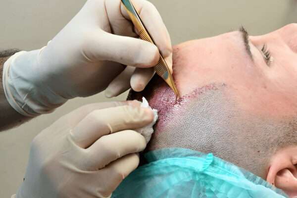 How to Avoid Hair Transplant Scarring hair transplant UK