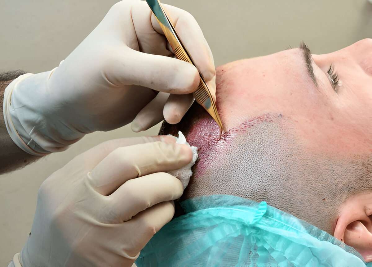 hair transplant UK