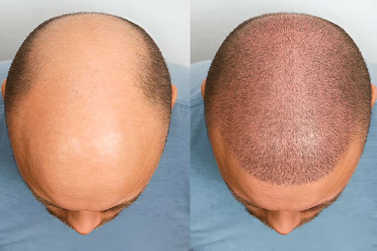 hair transplant Cardiff