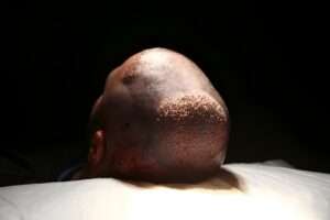 Is Hair Transplant Surgery Permanent or Temporary? Hair Transplant