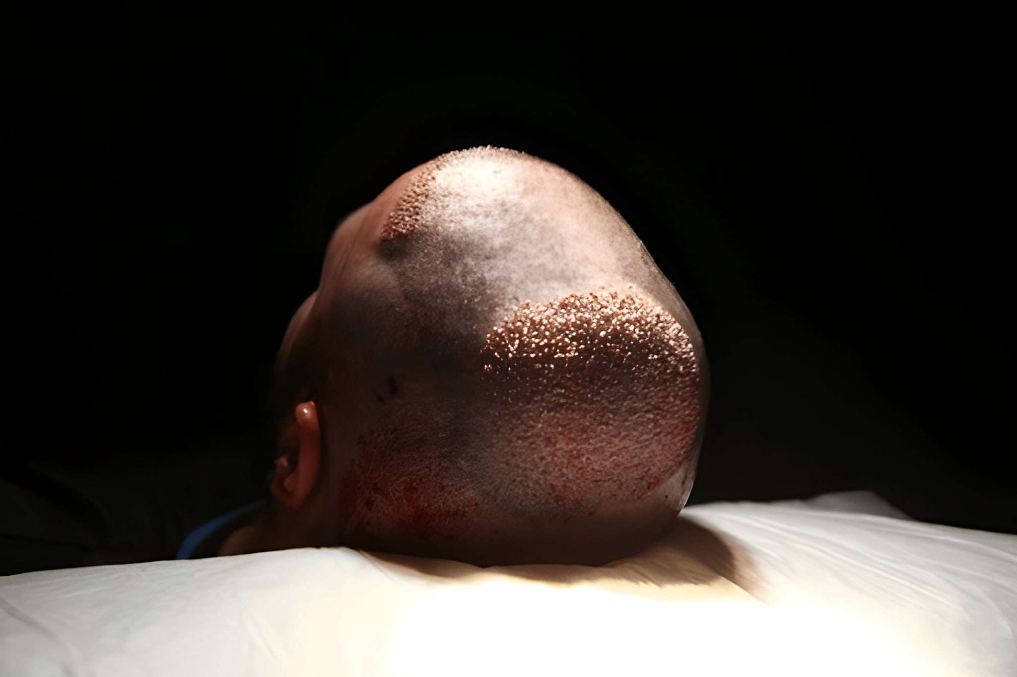 Hair Transplant