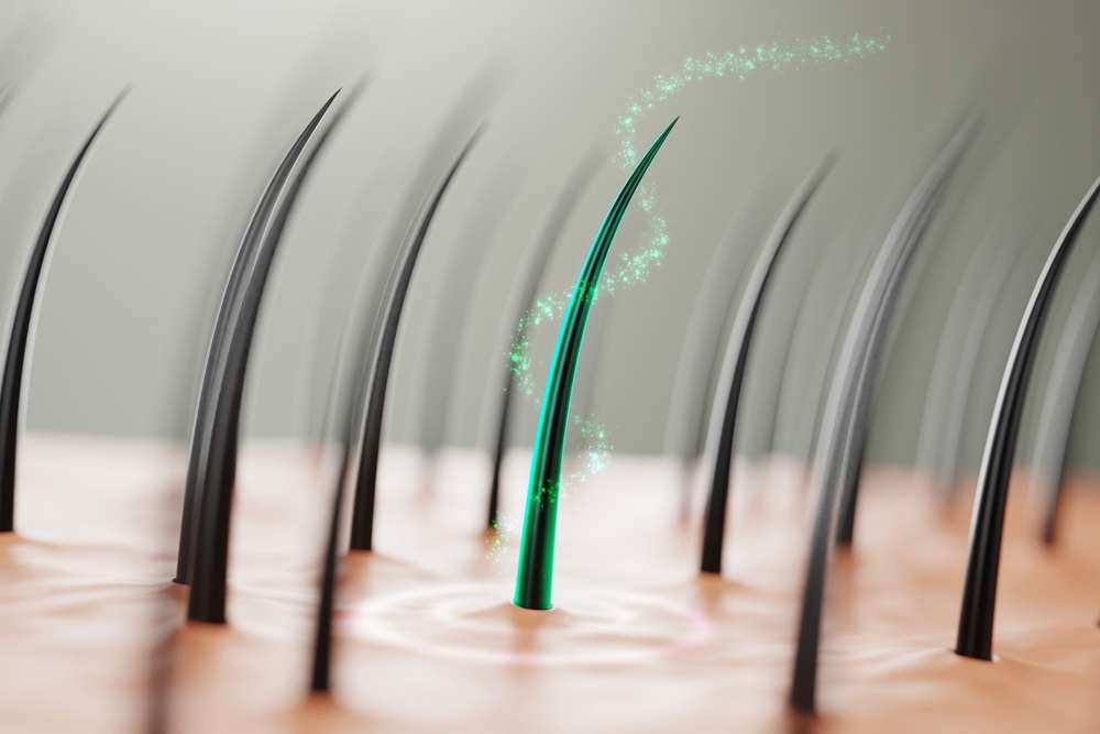 hair transplant London