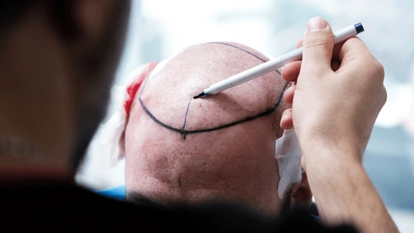 Hair Transplant