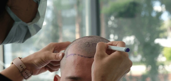 best age for hair transplant