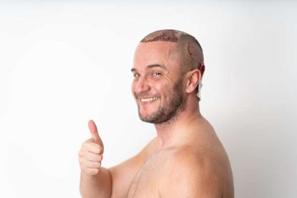 bad hairline