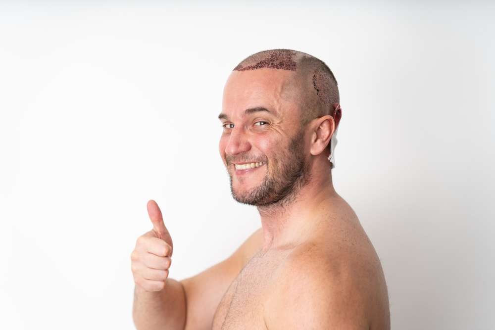 bad hairline