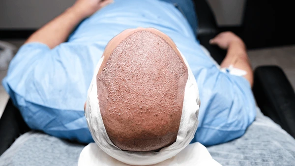 Jude Law hair transplant before and after