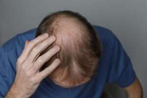 scalp Pigmentation