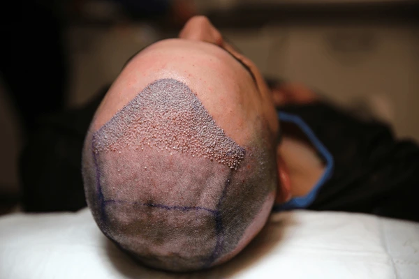 justin bieber hair transplant before and after