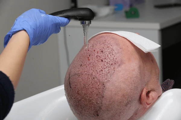 ketoconazole Shampoo